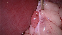 Sterilizzazione in Laparoscopia